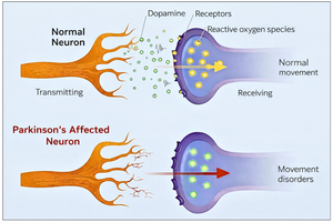 Parkinson's Disease