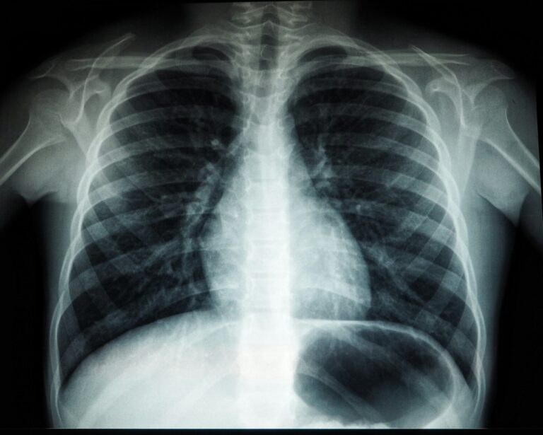 Tuberculosis in India — featured image