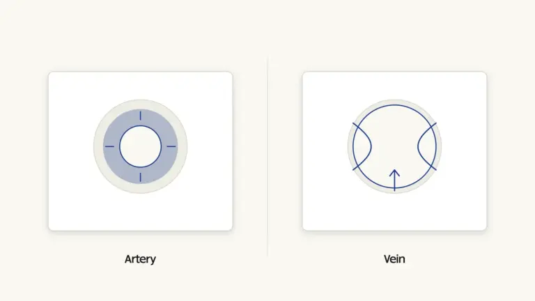 Wall thickness and lumen width drawn to the same outer diameter, plus the valve cusps only one of them has