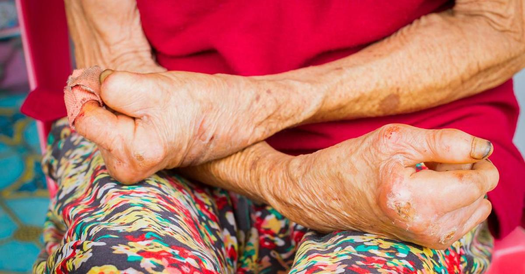 Leprosy Transmission